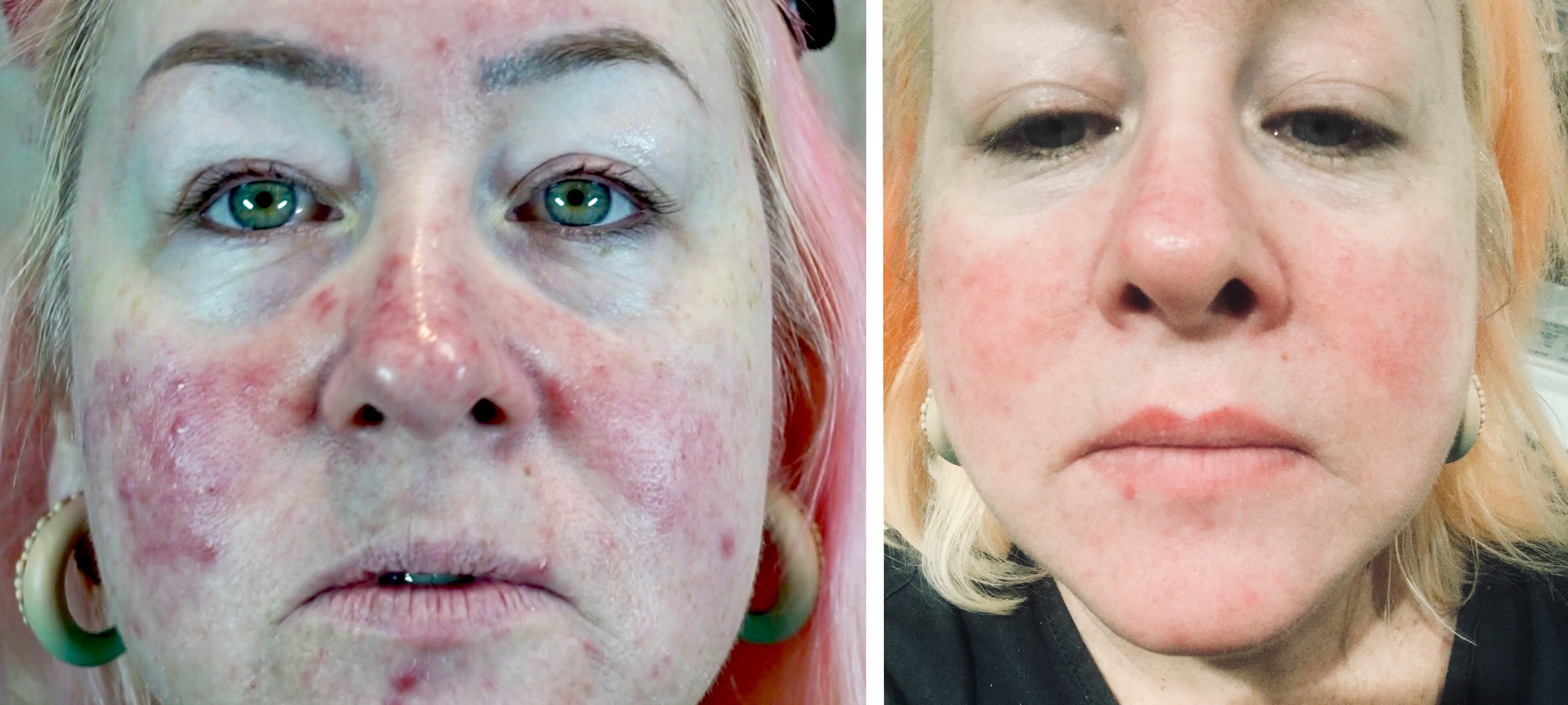 Rosacea Before And After Beauty And The Brows